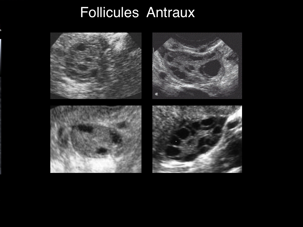 Le monitorage de l'ovulation