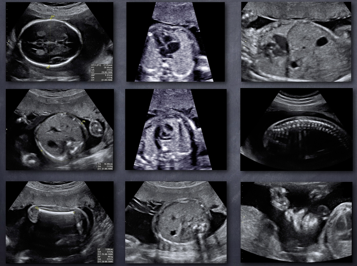 L’échographie au cours de la grossesse
