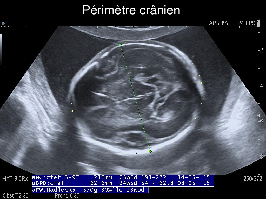 Au 2e trimestre