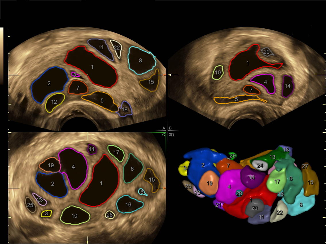 Le monitorage de l'ovulation